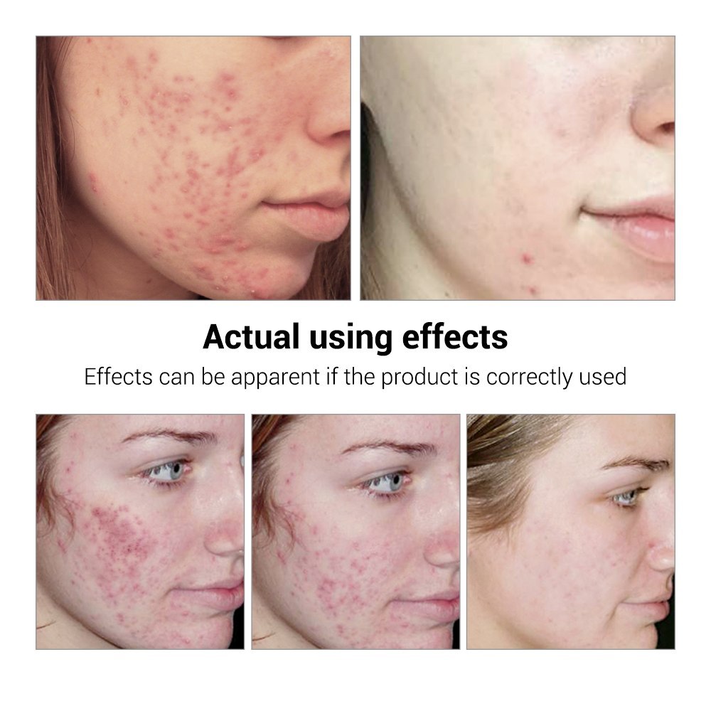 BREYLEE Acne Treatment Serum Face Facial Anti Acne Scar Removal Cream Skin Care Whitening Repair Pimple Remover For Acne BREYLEE Acne Treatment Serum Face Facial Anti Acne Scar Removal Cream Skin Care Whitening Repair Pimple Remover For Acne